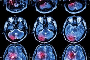 vascular stroke ssdi benefits