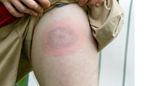Can I Get Social Security Disability Benefits for Lyme Disease?