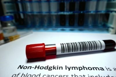 What Is the Disability Rating for Non-Hodgkin’s Lymphoma?