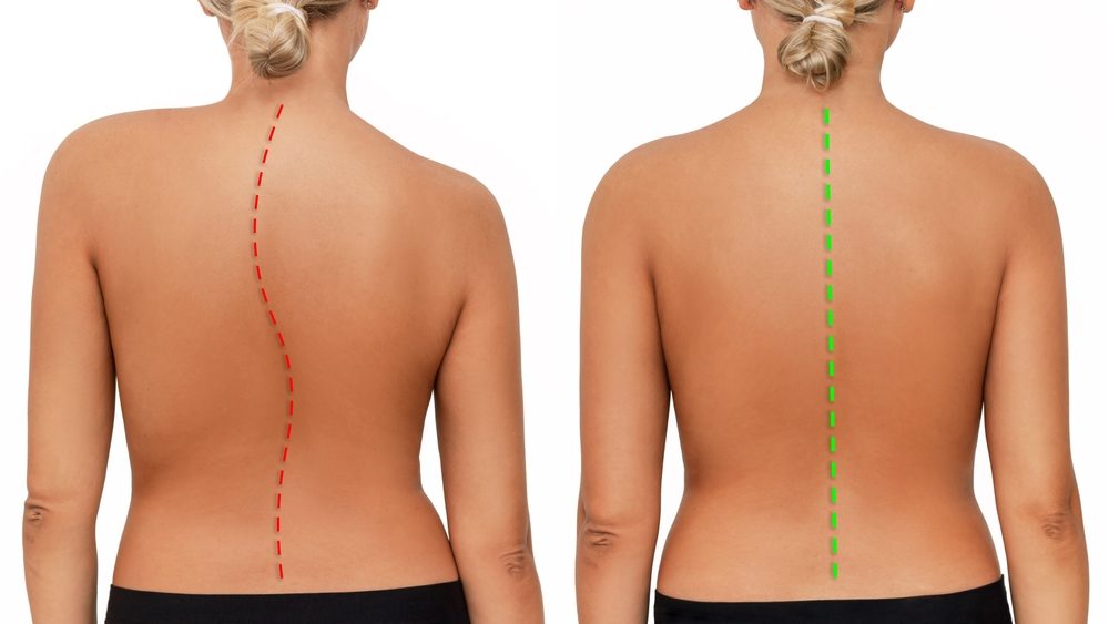 Does Scoliosis Qualify For Disability Benefits Does scoliosis qualify for disability benefits